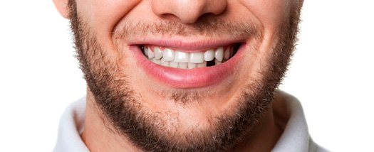 Por-que-se-producen-perdidas-dentales.jpg Por-que-se-producen-perdidas-dentales.jpg
